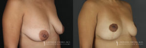 Breast Lift Patient 7 Before & After C