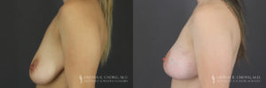 Breast Augmentation/Mastopexy Patient 2 Before & After A