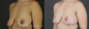 Breast Augmentation/Mastopexy Patient 2 Before & After B