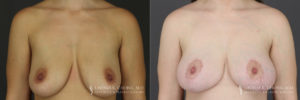 Breast Augmentation/Mastopexy Patient 2 Before & After C