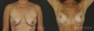 Breast Augmentation/Mastopexy Patient 3 Before & After A