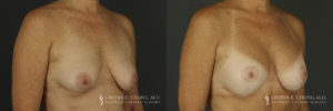 Breast Augmentation/Mastopexy Patient 3 Before & After C