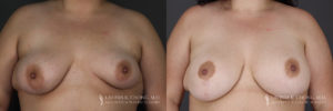 Breast Augmentation/Mastopexy Patient 4 Before & After A