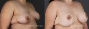 Breast Augmentation/Mastopexy Patient 4 Before & After B