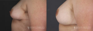 Breast Augmentation/Mastopexy Patient 4 Before & After C