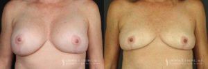 Implant Explantation/Mastopexy Patient 2695 Before & After A