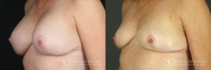 Implant Explantation/Mastopexy Patient 2695 Before & After B