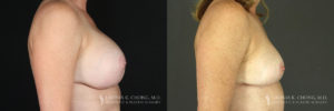 Implant Explantation/Mastopexy Patient 2695 Before & After C