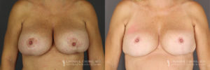 Implant Explantation/Mastopexy Patient 5928 Before & After A
