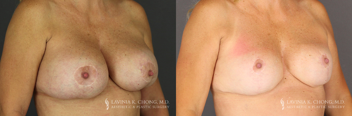 Implant Explantation/Mastopexy Patient 5928 Before & After B