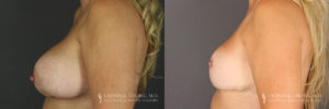 Implant Explantation/Mastopexy Patient 5928 Before & After C