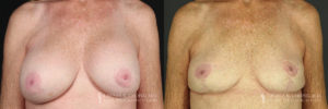 Implant Explantation/Mastopexy Patient 6221 Before & After A