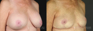 Implant Explantation/Mastopexy Patient 6221 Before & After B