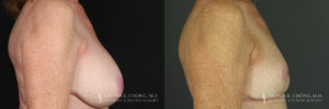 Implant Explantation/Mastopexy Patient 6221 Before & After C