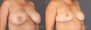 Implant Explantation/Mastopexy Patient 8308 Before & After B