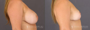 Implant Explantation/Mastopexy Patient 8308 Before & After C