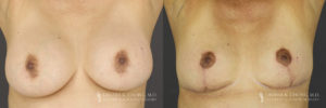 Implant Explantation/Mastopexy Patient 8465 Before & After A