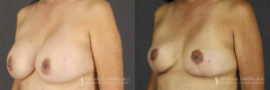 Implant Explantation/Mastopexy Patient 8465 Before & After B