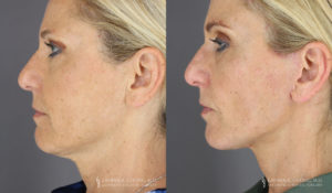 Neck Lift/Facelift Patient 4195 Before & After A