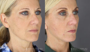 Neck Lift/Facelift Patient 4195 Before & After B