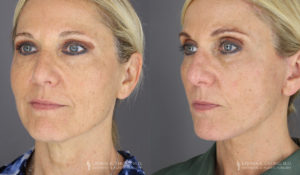 Neck Lift/Facelift Patient 4195 Before & After C