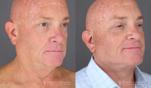 Neck Lift/Facelift Patient 8352 Before & After A