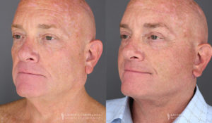 Neck Lift/Facelift Patient 8352 Before & After B