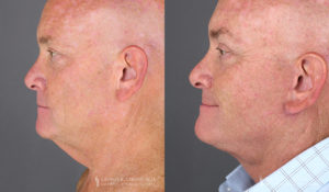 Neck Lift/Facelift Patient 8352 Before & After C