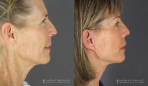 Neck Lift/Facelift Patient 8738 Before & After A