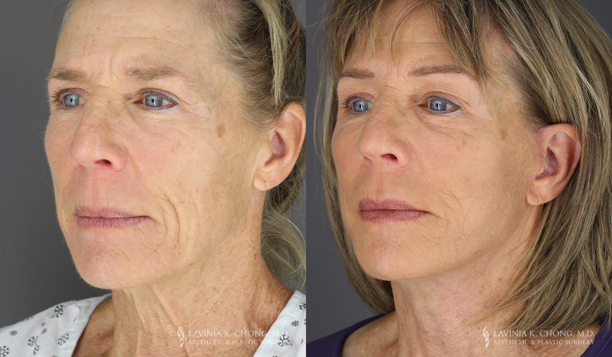Neck Lift/Facelift Patient 8738 Before & After B