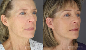 Neck Lift/Facelift Patient 8738 Before & After C