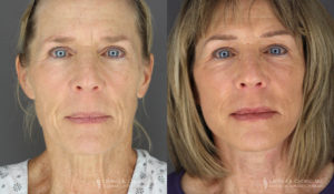 Neck Lift/Facelift Patient 8738 Before & After D