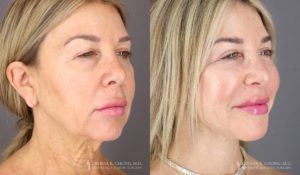 Neck Lift/Facelift Patient 1964 Before & After A