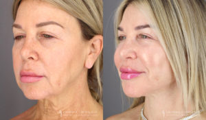 Neck Lift/Facelift Patient 1964 Before & After B