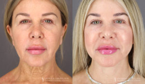 Neck Lift/Facelift Patient 1964 Before & After C