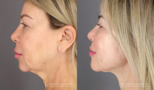 Neck Lift/Facelift Patient 1964 Before & After D