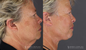 Neck Lift/Facelift Patient 7400 Before & After A