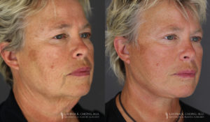 Neck Lift/Facelift Patient 7400 Before & After B