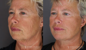 Neck Lift/Facelift Patient 7400 Before & After C