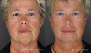 Neck Lift/Facelift Patient 7400 Before & After D