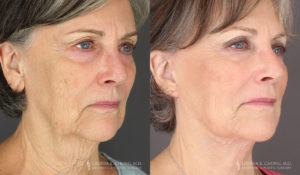 Neck Lift/Facelift Patient 7756 Before & After A