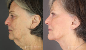 Neck Lift/Facelift Patient 7756 Before & After B