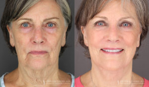 Neck Lift/Facelift Patient 7756 Before & After C