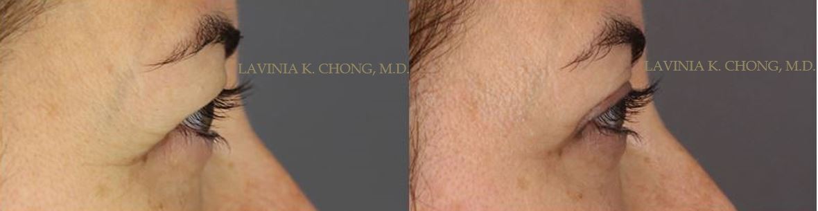 Patient pre-op diagnosis of Blepharoptosis (droopy eyelid). Real Patient Results at 1 year Post Op Upper Eyelid Lift with board certified female plastic surgeon in Newport Beach, Orange County.