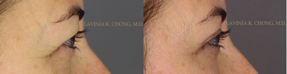 Patient pre op diagnosis of blepharoptosis droopy eyelid Real patient results at 1 year post op upper eyelid lift with board certified female plastic surgeon in newport beach orange county