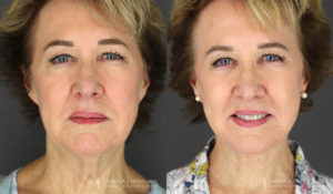 Neck Lift/Facelift Patient 2211 Before & After A