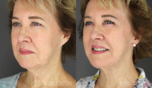 Neck Lift/Facelift Patient 2211 Before & After B