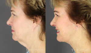 Neck Lift/Facelift Patient 2211 Before & After C