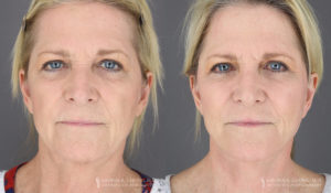 Neck Lift/Facelift Patient 3565 B&A A