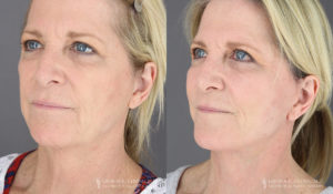 Neck Lift/Facelift Patient 3565 B&A B